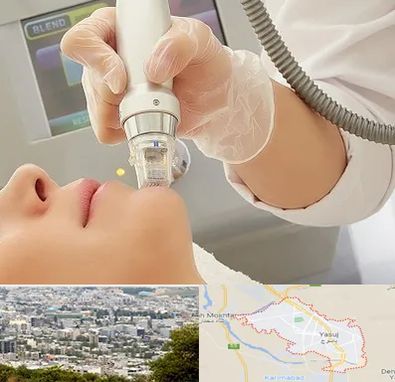 آر اف فرکشنال در یاسوج