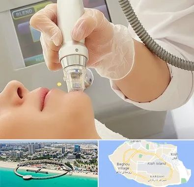 آر اف فرکشنال در کیش