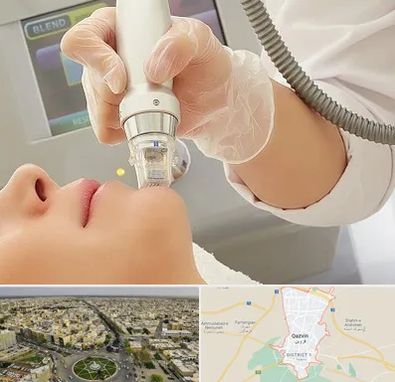 آر اف فرکشنال در قزوین