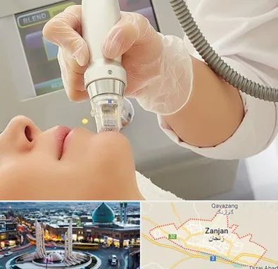 آر اف فرکشنال در زنجان