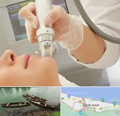 آر اف فرکشنال در بندر انزلی