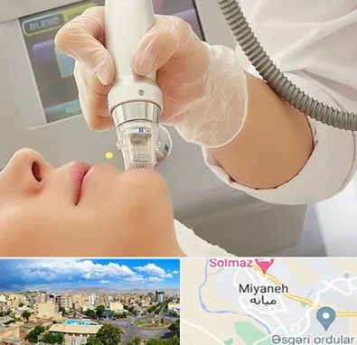 آر اف فرکشنال در میانه