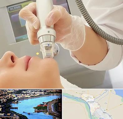 آر اف فرکشنال در خرمشهر