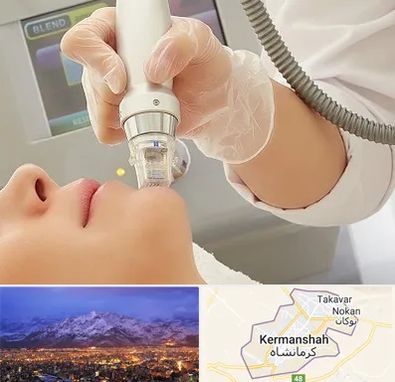 آر اف فرکشنال در کرمانشاه