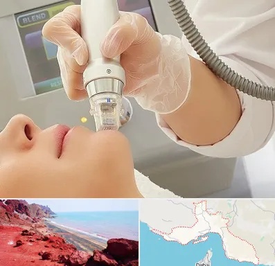 آر اف فرکشنال در هرمزگان