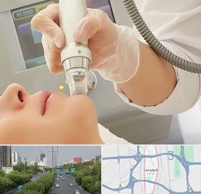 آر اف فرکشنال در توانیر