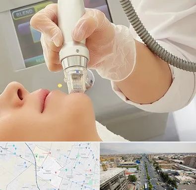 آر اف فرکشنال در حصارک کرج