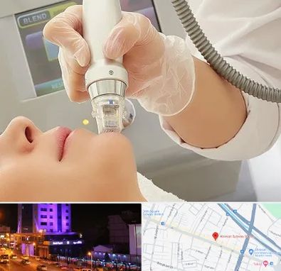 آر اف فرکشنال در آبرسان تبریز