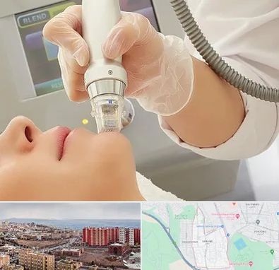 آر اف فرکشنال در سهند تبریز