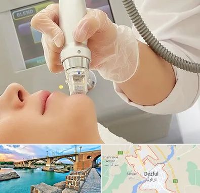 آر اف فرکشنال در دزفول