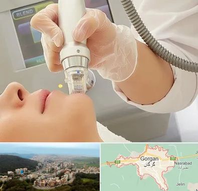 آر اف فرکشنال در گرگان