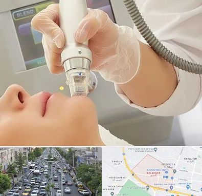 آر اف فرکشنال در گلشهر کرج