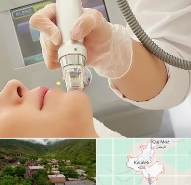آر اف فرکشنال در کلاله