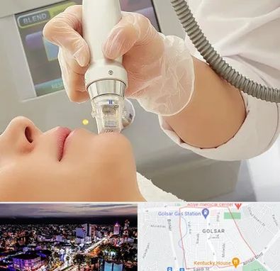 آر اف فرکشنال در گلسار رشت 