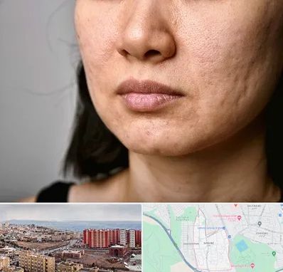 سابسیژن جای جوش در سهند تبریز