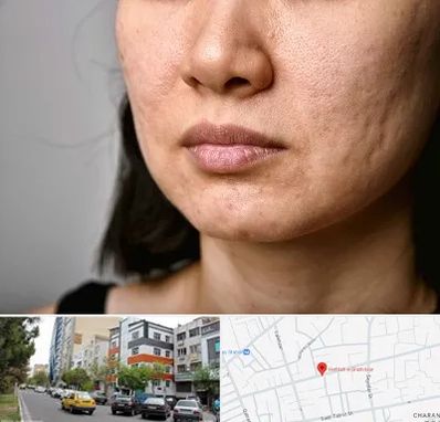 سابسیژن جای جوش در هفده شهریور تبریز