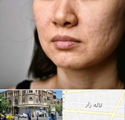 سابسیژن جای جوش در لاله زار