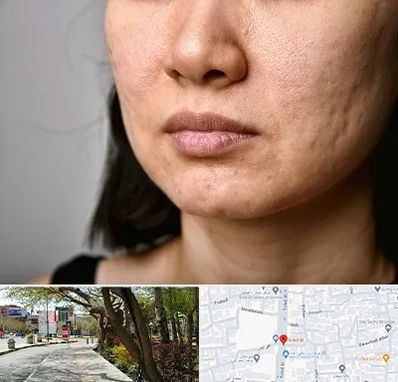 سابسیژن جای جوش در خیابان توحید اصفهان