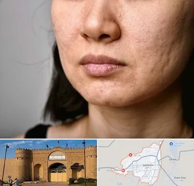 سابسیژن جای جوش در ایرانشهر
