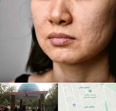 سابسیژن جای جوش در کیانشهر