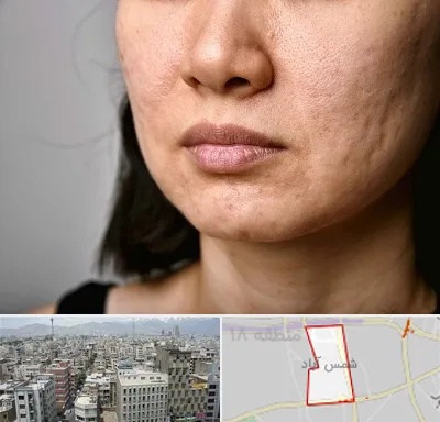 سابسیژن جای جوش در شمس آباد تهران
