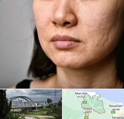 سابسیژن جای جوش در چالوس