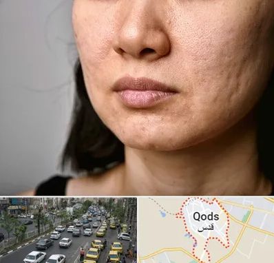 سابسیژن جای جوش در شهر قدس