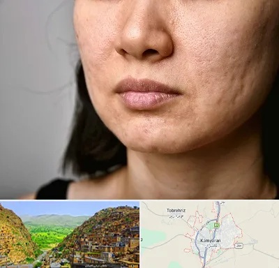 سابسیژن جای جوش در کامیاران