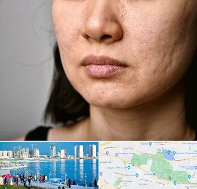 سابسیژن جای جوش در چیتگر 