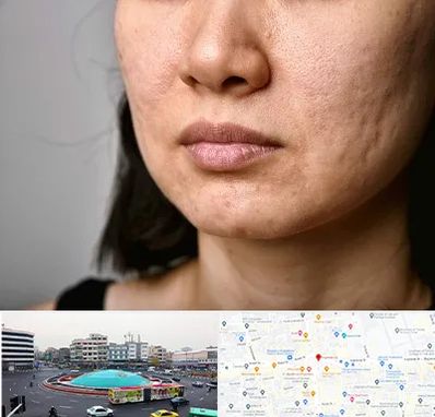 سابسیژن جای جوش در میدان انقلاب 