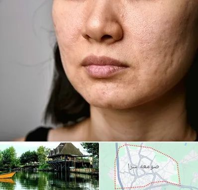 سابسیژن جای جوش در صومعه سرا