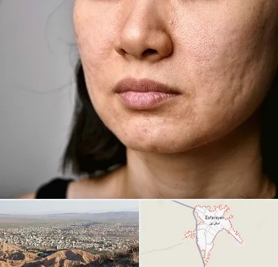 سابسیژن جای جوش در اسفراین