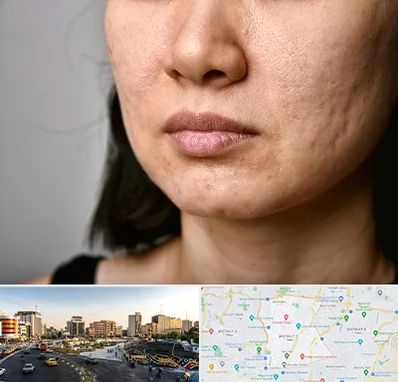 سابسیژن جای جوش در منطقه 7 تهران 