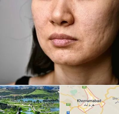 سابسیژن جای جوش در خرم آباد