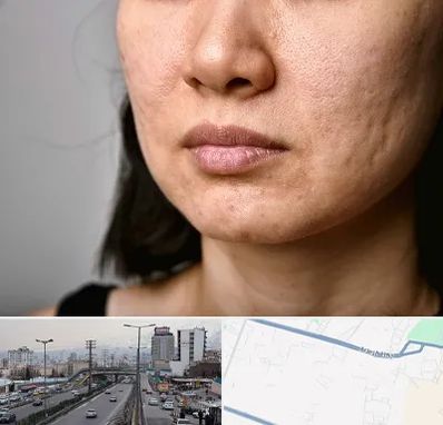 سابسیژن جای جوش در بلوار ارتش