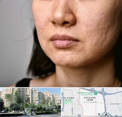 سابسیژن جای جوش در آپادانا