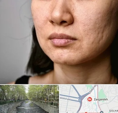 سابسیژن جای جوش در زرگنده