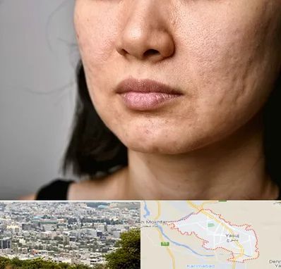 سابسیژن جای جوش در یاسوج