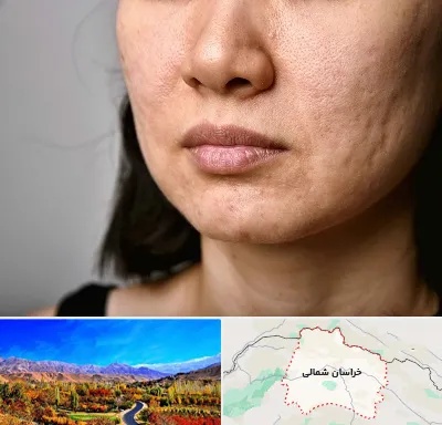 سابسیژن جای جوش در خراسان شمالی