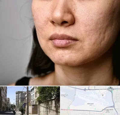 سابسیژن جای جوش در مهرآباد