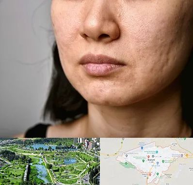 سابسیژن جای جوش در بجنورد