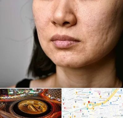 سابسیژن جای جوش در میدان ولیعصر 