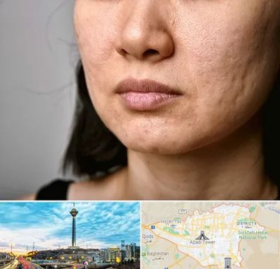 سابسیژن جای جوش در تهران