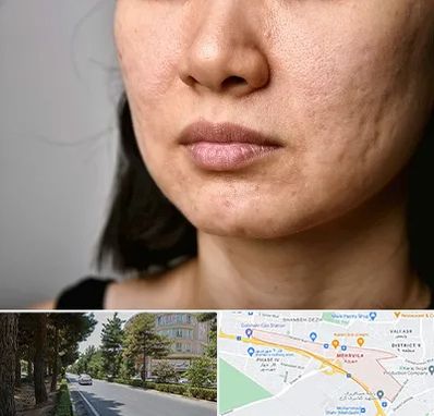 سابسیژن جای جوش در مهرویلا کرج