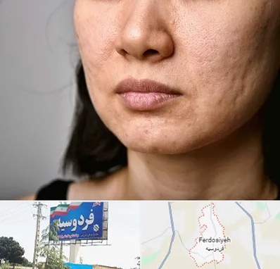 سابسیژن جای جوش در فردوسیه شهریار