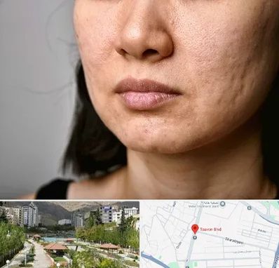 سابسیژن جای جوش در بلوار تعاون