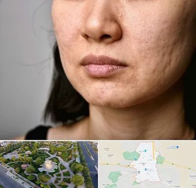 سابسیژن جای جوش در کاشمر