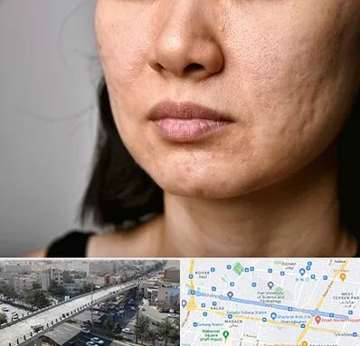 سابسیژن جای جوش در فرجام