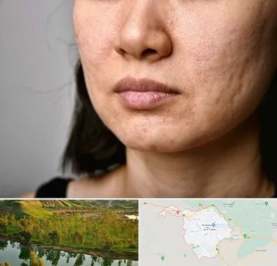 سابسیژن جای جوش در بهبهان