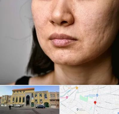 سابسیژن جای جوش در زنبیل آباد قم